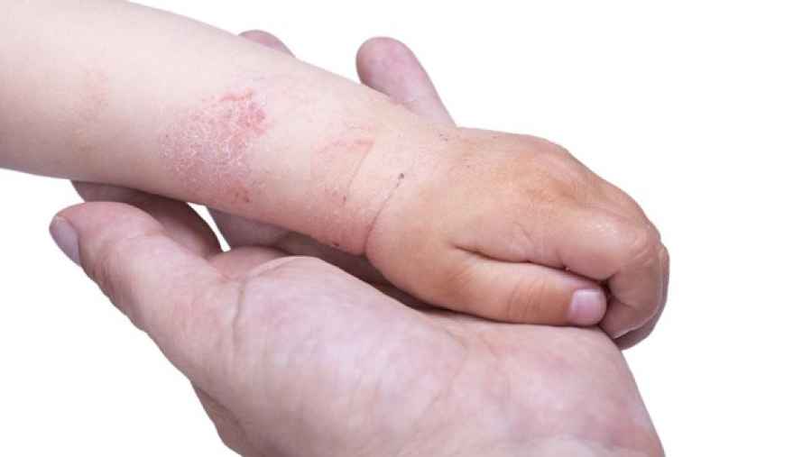 Aprueban el uso en ni&ntilde;os de un tratamiento innovador para la dermatitis
