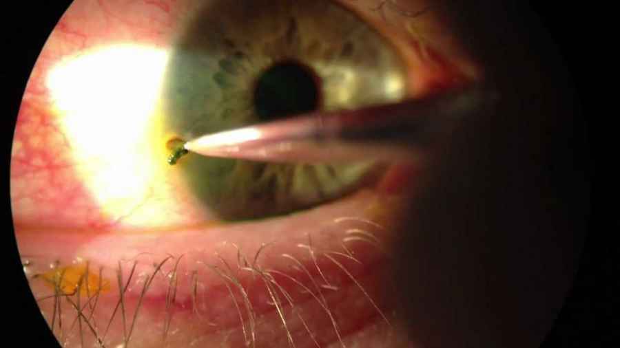 Crean un dispositivo que libera medicamentos en los ojos