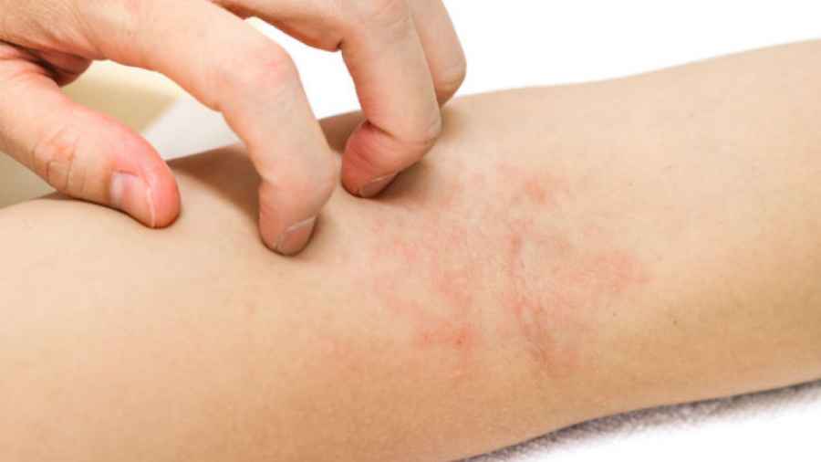 Campaña de detección gratuita de Dermatitis Atópica
