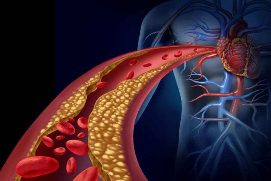 Descubren cómo el LDL entra en las paredes de las arterias