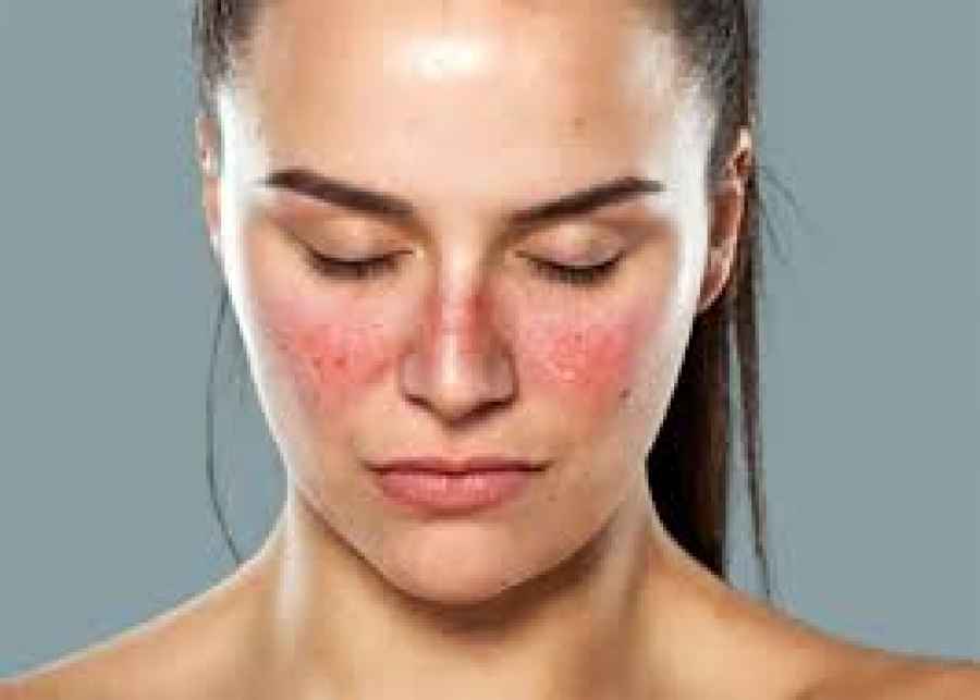 VGLL3, la molécula que hace que las mujeres sean más propensas a contraer lupus