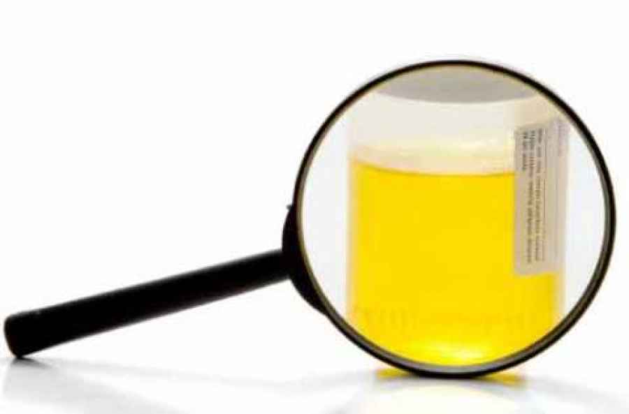 Prueba de orina para detectar c&aacute;ncer de colon