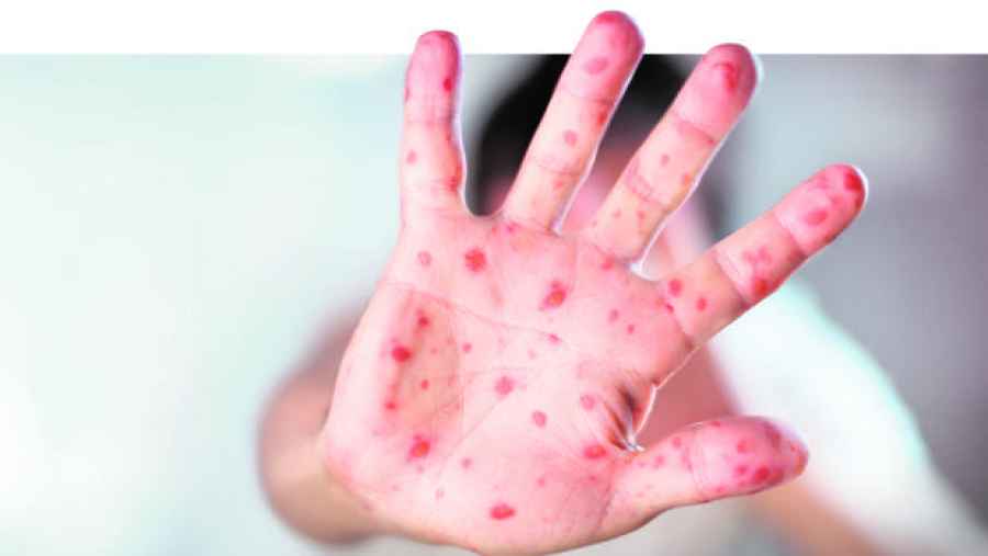 Dos casos autóctonos de sarampión: son los primeros en 18 años