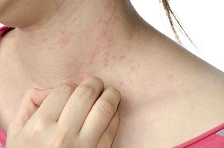 Dermatitis atópica en adolescentes, una consulta prevalente