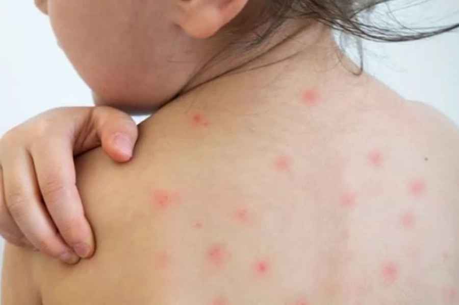 El &uacute;ltimo caso confirmado fue el 19 de marzo por lo que transcurrieron m&aacute;s de las 12 semanas requeridas para dar por finalizado el brote que comenz&oacute; en agosto de 2019.