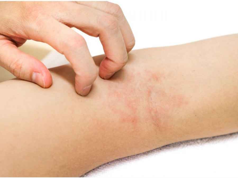 La dermatitis at&oacute;pica no es s&oacute;lo un brote en la piel