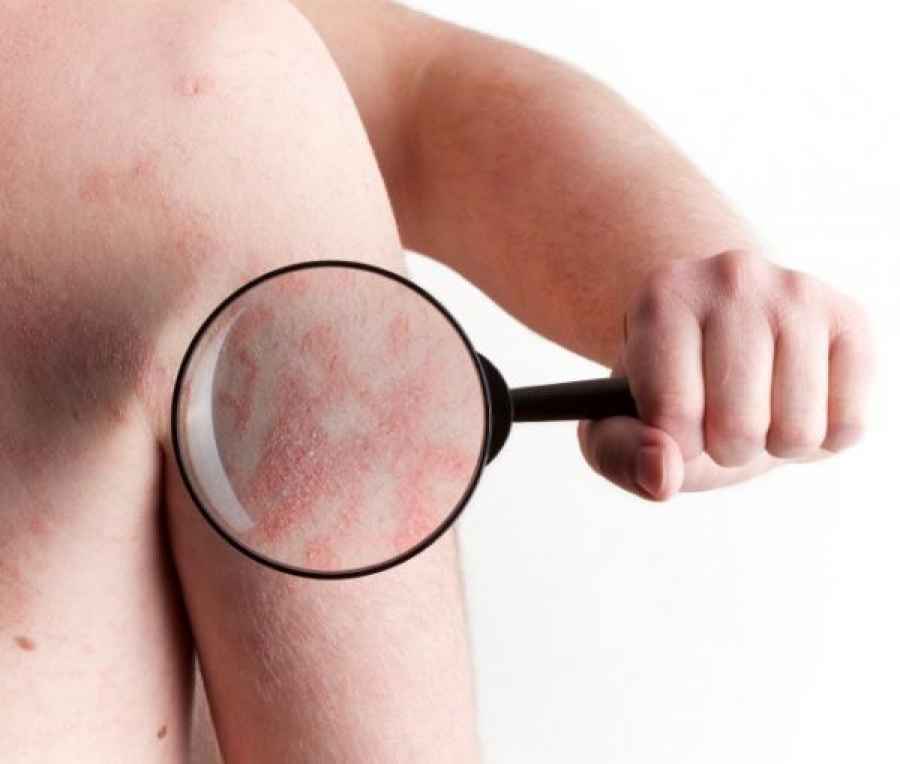 Nueva alternativa terap&eacute;utica en psoriasis