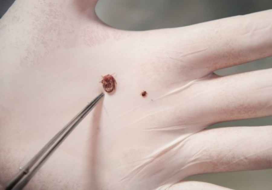 Alerta en Salta: un beb&eacute; y un joven fueron infectados de rickettsiosis por picaduras de garrapatas