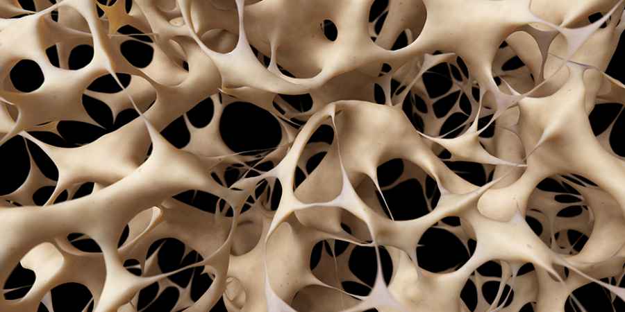 Descubren una nueva forma de osteoporosis hereditaria