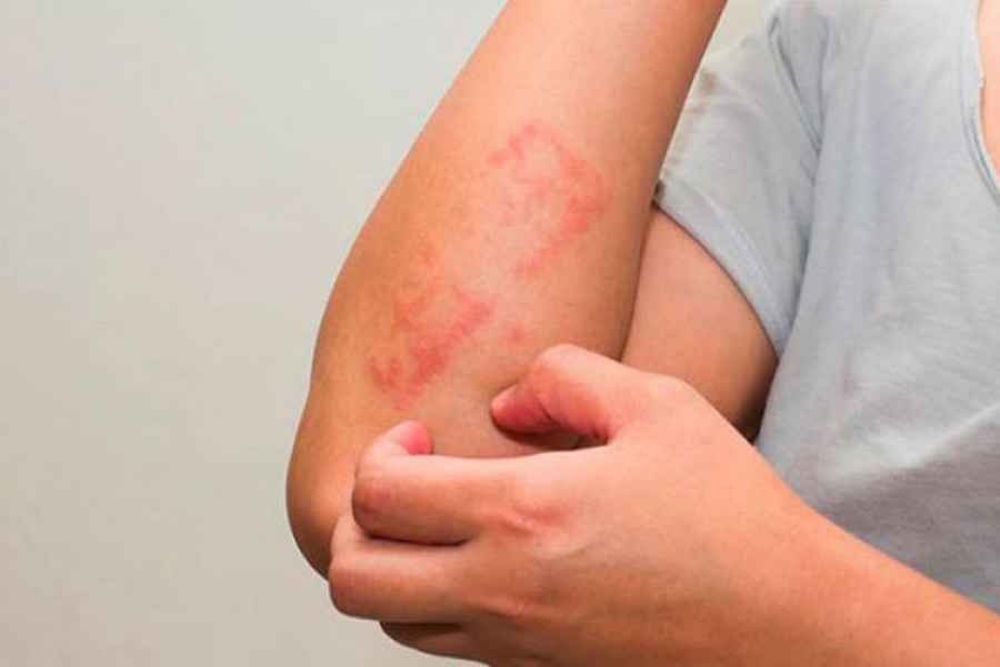 ●	Los especialistas advierten una gran disminuci&oacute;n de las consultas y aseguran que los pacientes con psoriasis no deben suspender los controles ni los tratamientos. Enfermedades como la psoriasis no pueden esperar. En tal sentido, tanto en el sistema p&uacute;blico como en el privado se han tomado las medidas correspondientes para garantizar una atenci&oacute;n segura.   