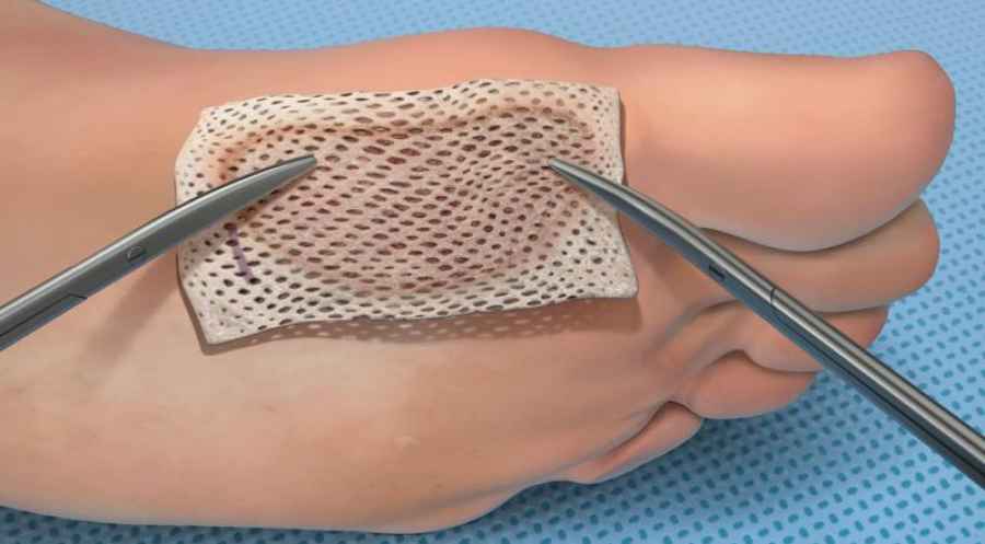 Investigadores del CONICET y la UNLP imprimen en 3D ap&oacute;sitos para pie diab&eacute;tico